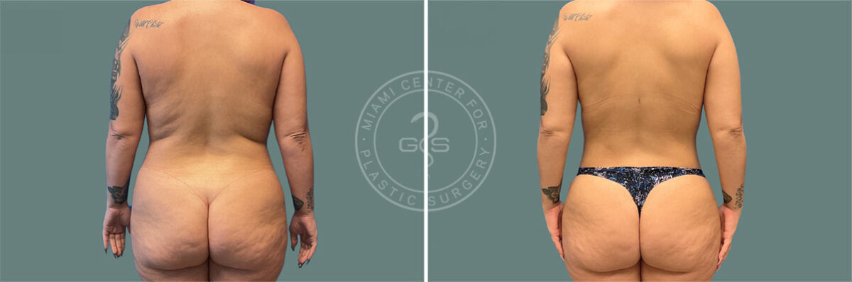 Liposuction before and after photos in Miami Beach, FL, Patient 7418