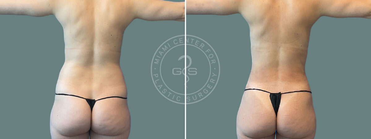 Liposuction before and after photos in Miami Beach, FL, Patient 7450