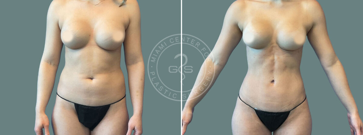 Liposuction before and after photos in Miami Beach, FL, Patient 7450