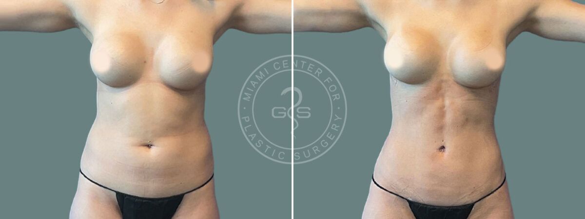 Liposuction before and after photos in Miami Beach, FL, Patient 7450