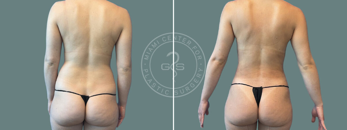 Liposuction before and after photos in Miami Beach, FL, Patient 7450