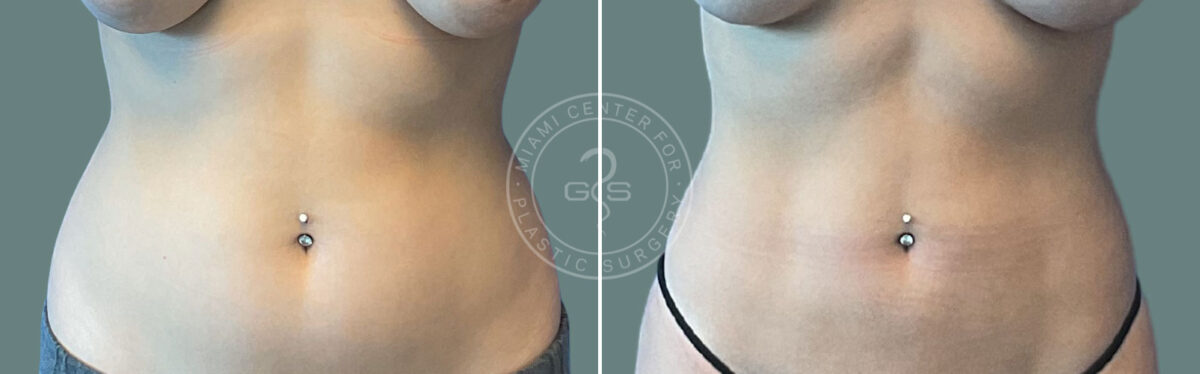 Liposuction before and after photos in Miami Beach, FL, Patient 7486