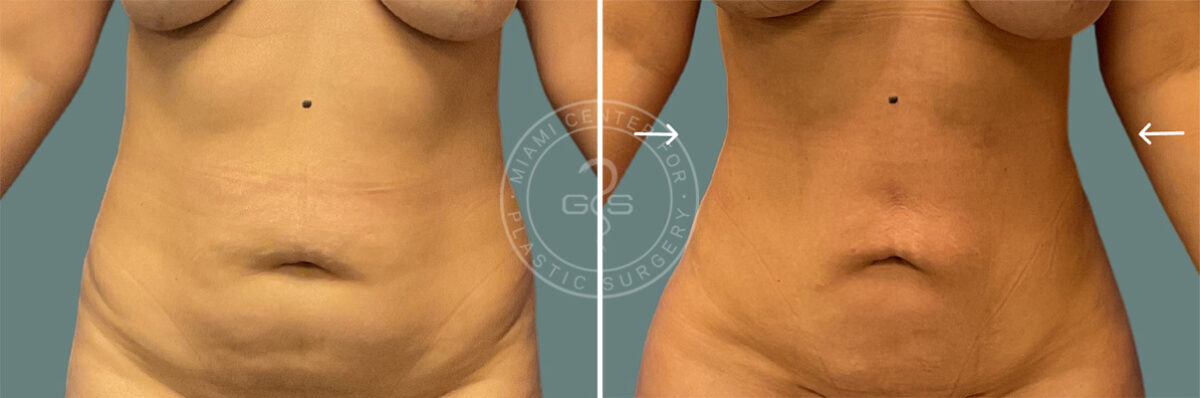 Liposuction before and after photos in Miami Beach, FL, Patient 7499