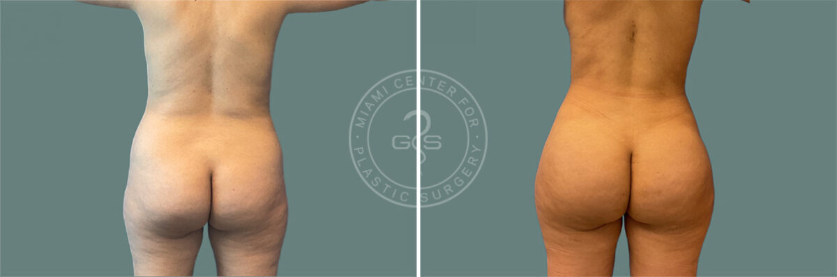 Liposuction before and after photos in Miami Beach, FL, Patient 7499