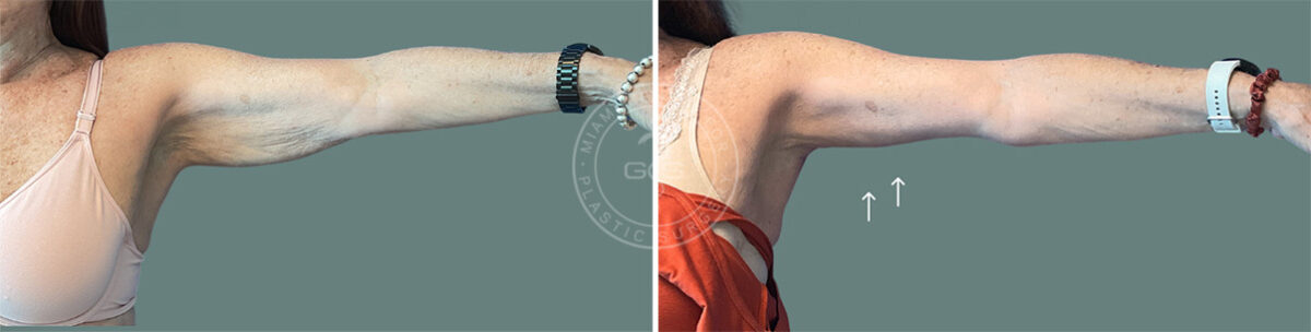 Arm Lift before and after photos in Miami Beach, FL, Patient 7675