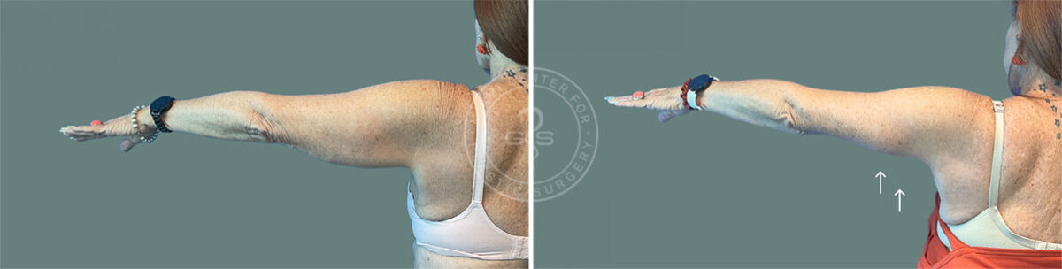 Arm Lift before and after photos in Miami Beach, FL, Patient 7675