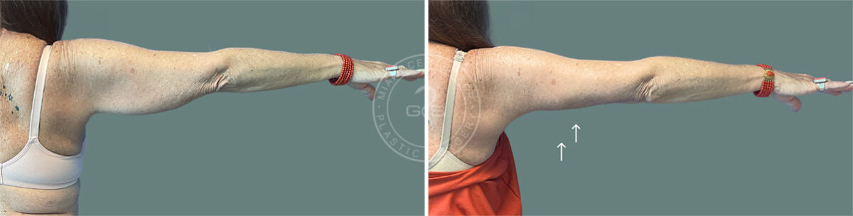 Arm Lift before and after photos in Miami Beach, FL, Patient 7675