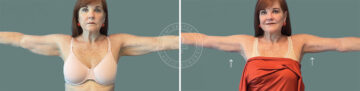 Arm Lift before and after photos in Miami Beach, FL, Patient 7675