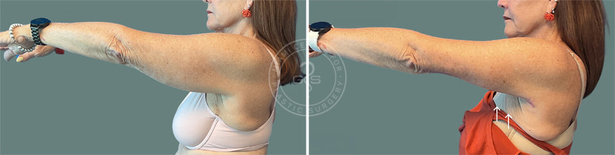 Arm Lift before and after photos in Miami Beach, FL, Patient 7675