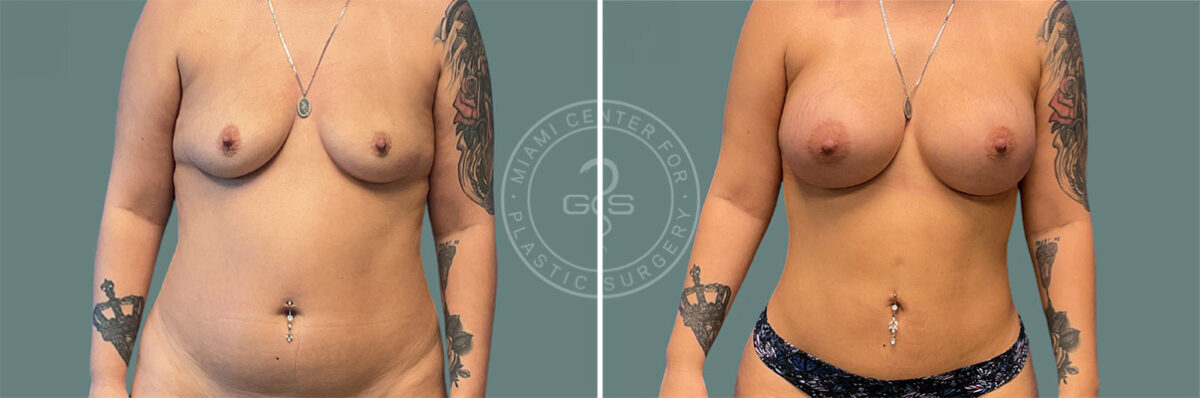 Liposuction before and after photos in Miami Beach, FL, Patient 7715