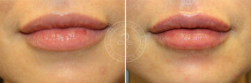 Fillers & Injectables before and after photos in Miami Beach, FL, Patient 7717