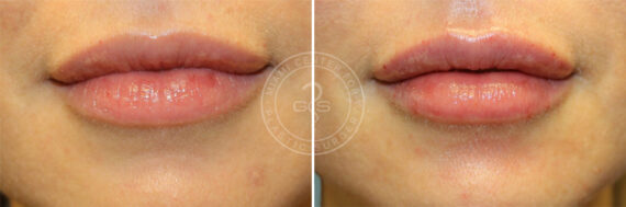 Fillers & Injectables before and after photos in Miami Beach, FL, Patient 7717