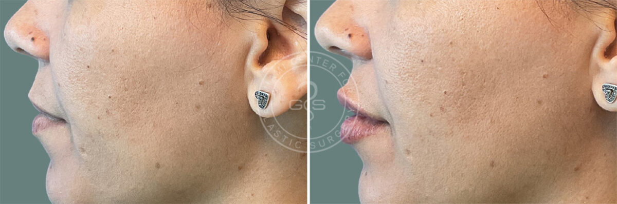 Fillers & Injectables before and after photos in Miami Beach, FL, Patient 7731