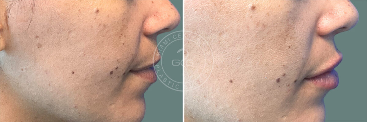 Fillers & Injectables before and after photos in Miami Beach, FL, Patient 7731