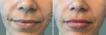 Fillers & Injectables before and after photos in Miami Beach, FL, Patient 7731