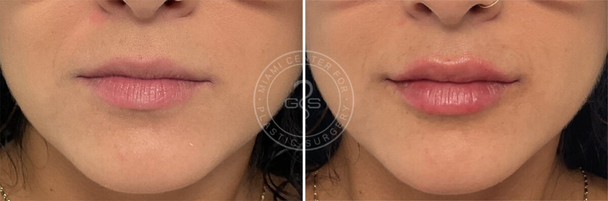 Fillers & Injectables before and after photos in Miami Beach, FL, Patient 7735