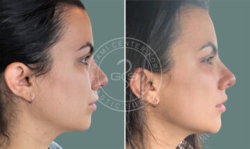 Fillers & Injectables before and after photos in Miami Beach, FL, Patient 7737