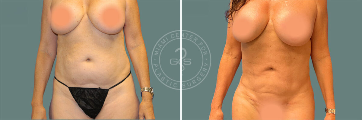 Liposuction before and after photos in Miami Beach, FL, Patient 7737