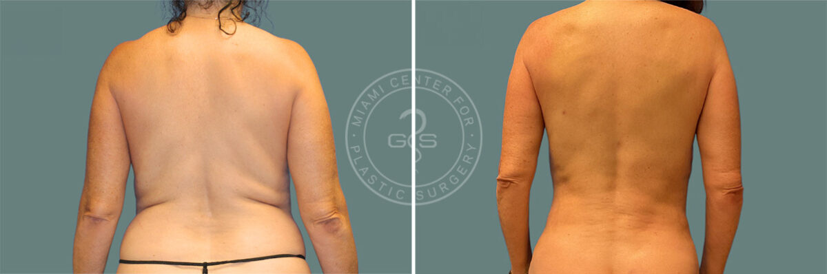 Liposuction before and after photos in Miami Beach, FL, Patient 7737