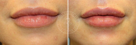 Fillers & Injectables before and after photos in Miami Beach, FL, Patient 7878