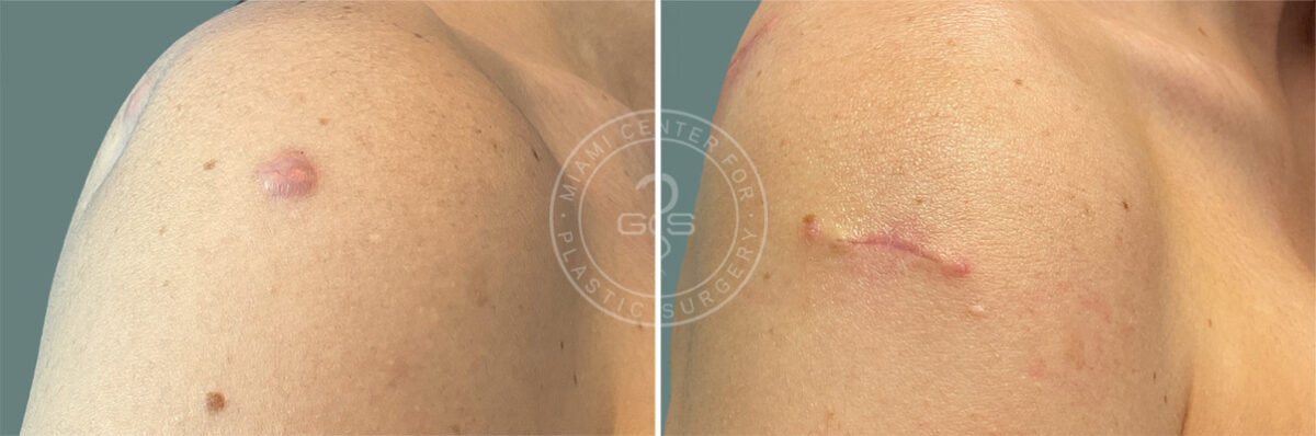 Keloid Removal before and after photos in Miami Beach, FL, Patient 7900