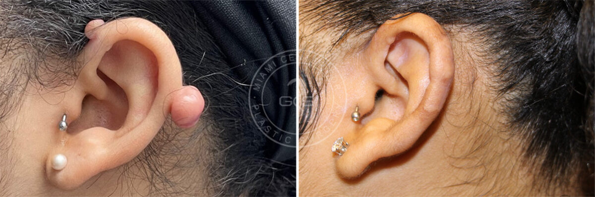 Keloid Removal before and after photos in Miami Beach, FL, Patient 7916