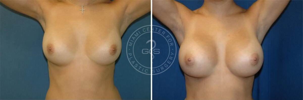 Breast Augmentation before and after photos in Miami Beach, FL, Patient 2638