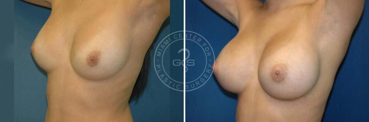 Breast Augmentation before and after photos in Miami Beach, FL, Patient 2638