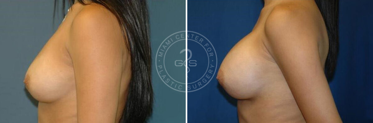 Breast Augmentation before and after photos in Miami Beach, FL, Patient 2638