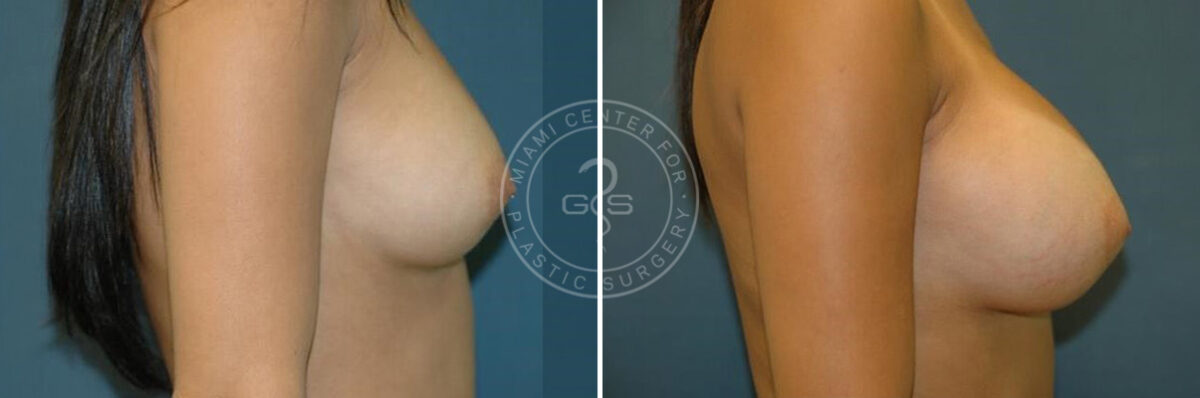 Breast Augmentation before and after photos in Miami Beach, FL, Patient 2638