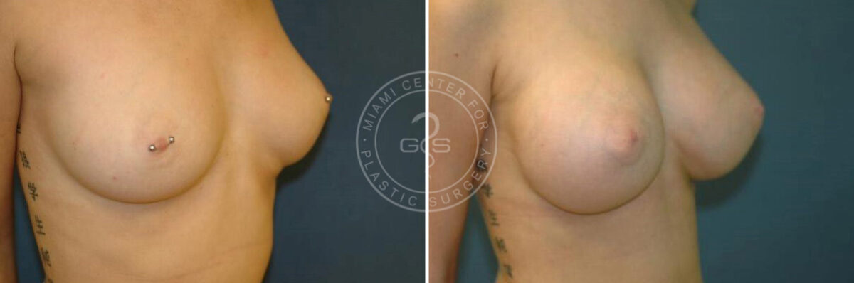 Breast Augmentation before and after photos in Miami Beach, FL, Patient 2657