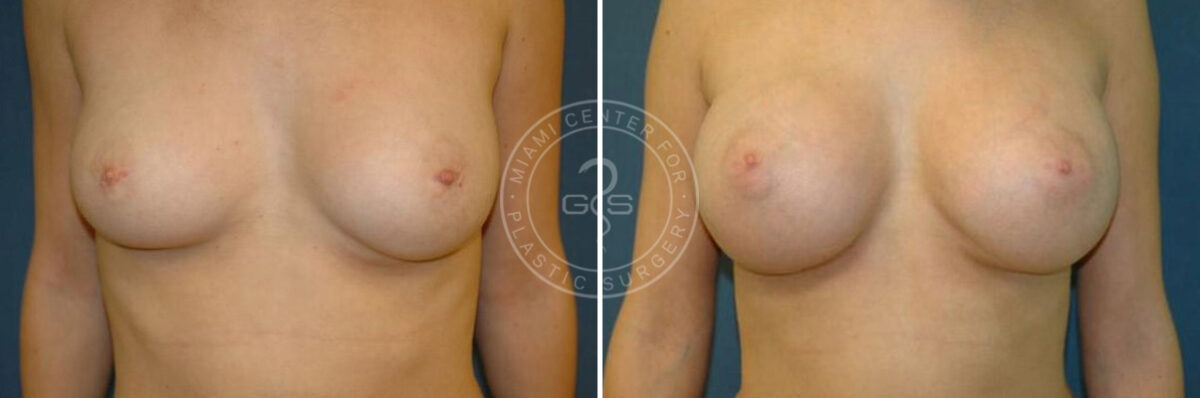 Breast Augmentation before and after photos in Miami Beach, FL, Patient 2657