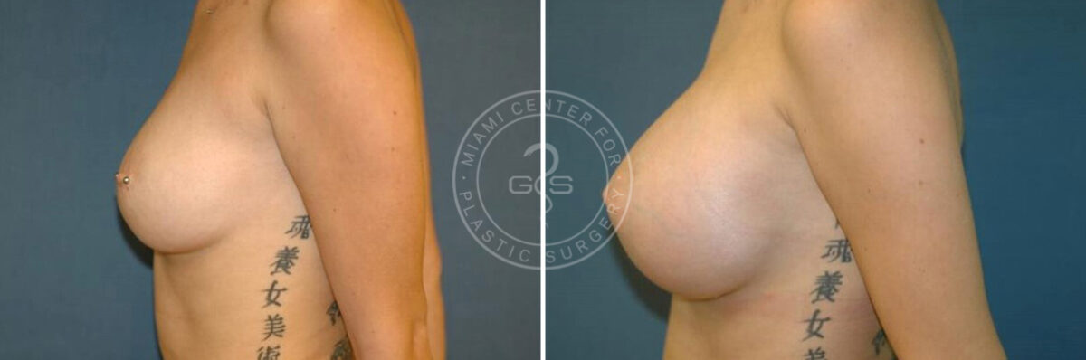 Breast Augmentation before and after photos in Miami Beach, FL, Patient 2657