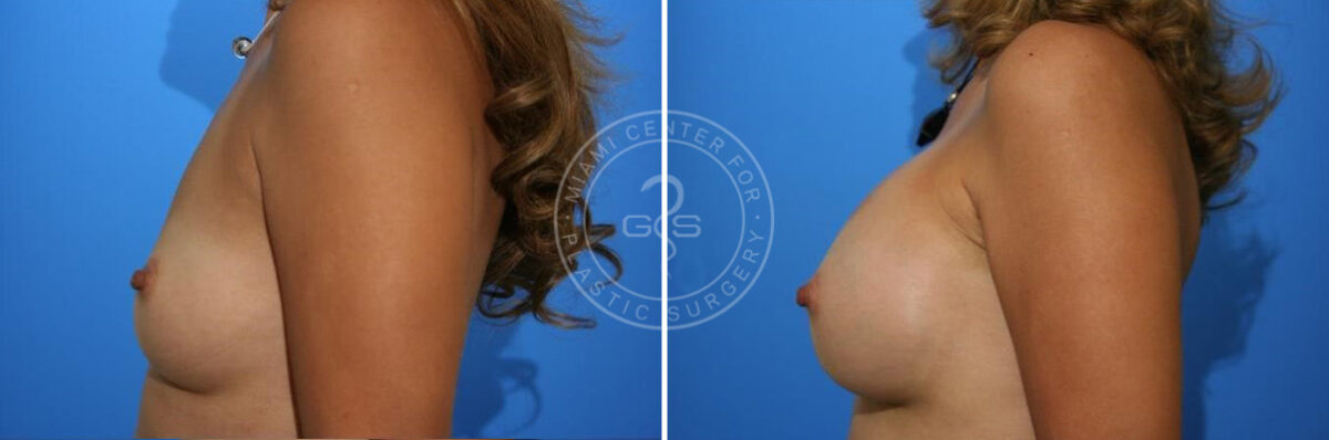 Breast Augmentation before and after photos in Miami Beach, FL, Patient 2674