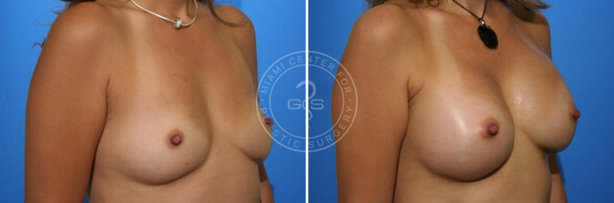 Breast Augmentation before and after photos in Miami Beach, FL, Patient 2674