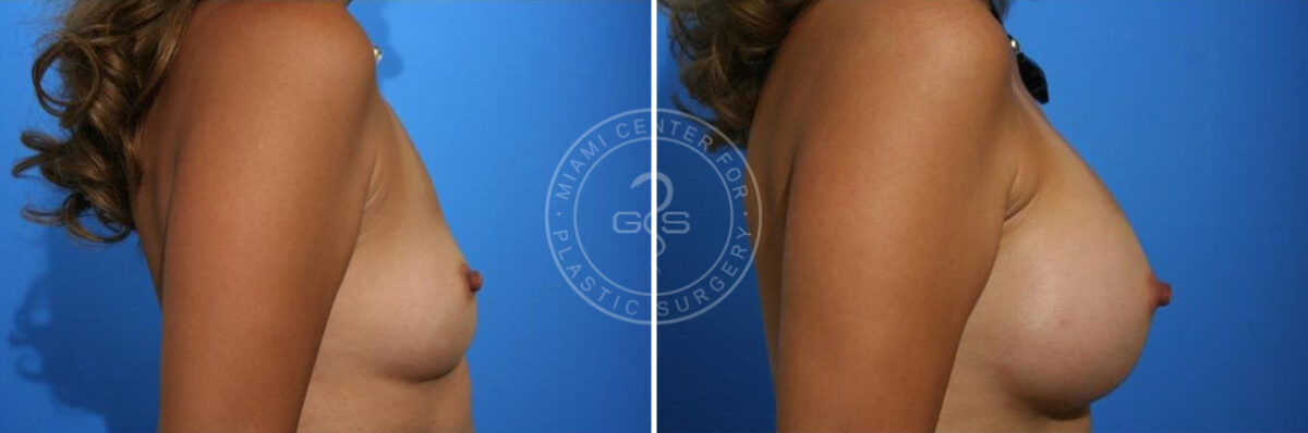 Breast Augmentation before and after photos in Miami Beach, FL, Patient 2674