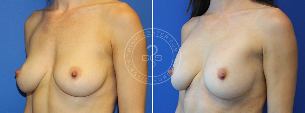 Breast Augmentation before and after photos in Miami Beach, FL, Patient 3712