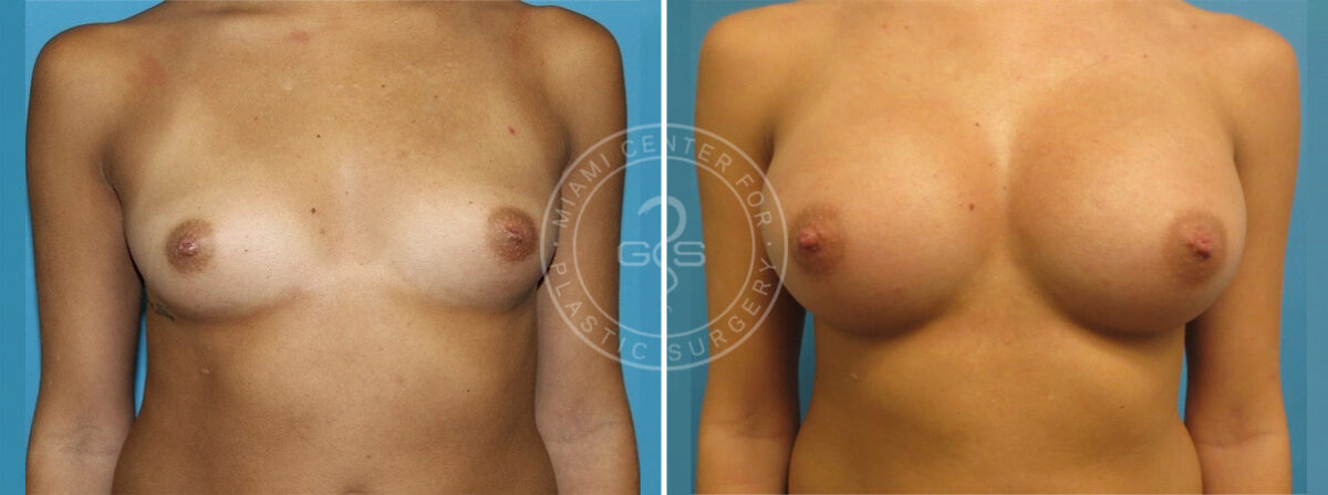 Breast Augmentation before and after photos in Miami Beach, FL, Patient 3716