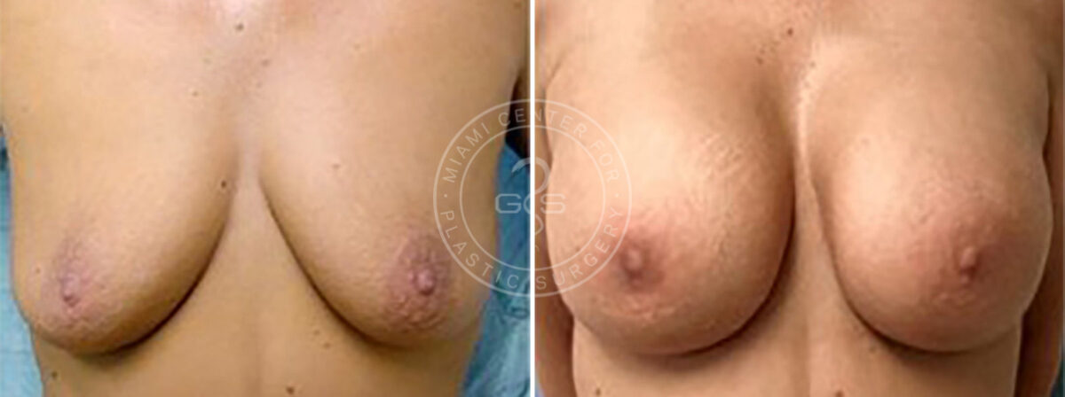 Breast Augmentation before and after photos in Miami Beach, FL, Patient 3727