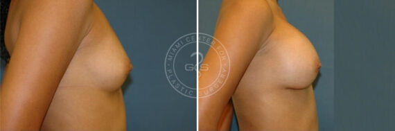 Breast Augmentation before and after photos in Miami Beach, FL, Patient 3731