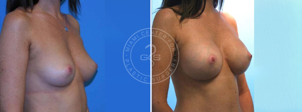 Breast Augmentation before and after photos in Miami Beach, FL, Patient 3738