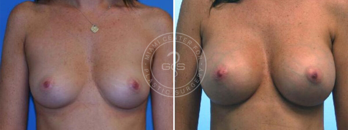 Breast Augmentation before and after photos in Miami Beach, FL, Patient 3738