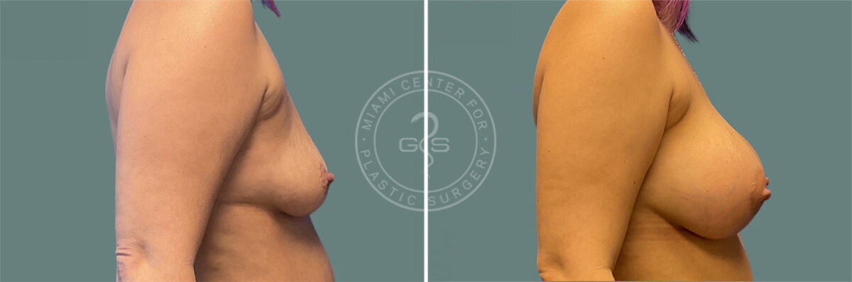 Breast Augmentation before and after photos in Miami Beach, FL, Patient 7338