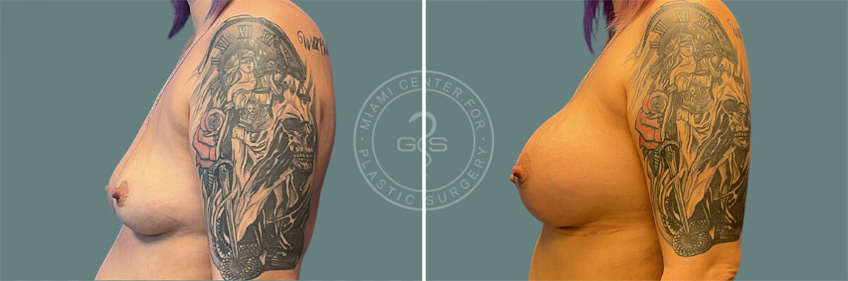 Breast Augmentation before and after photos in Miami Beach, FL, Patient 7338