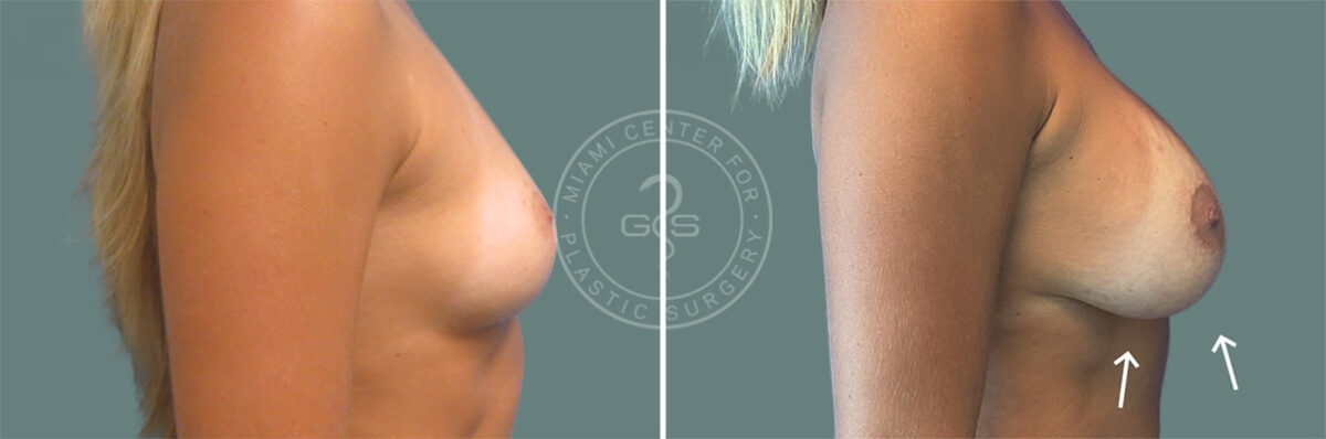 Breast Augmentation before and after photos in Miami Beach, FL, Patient 7348