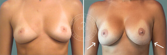 Breast Augmentation before and after photos in Miami Beach, FL, Patient 7348