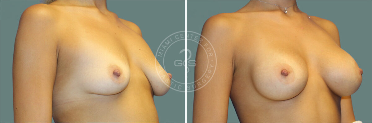 Breast Augmentation before and after photos in Miami Beach, FL, Patient 7355