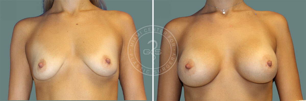 Breast Augmentation before and after photos in Miami Beach, FL, Patient 7355