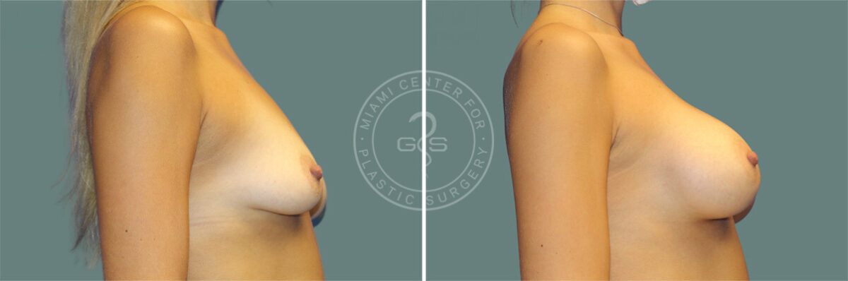 Breast Augmentation before and after photos in Miami Beach, FL, Patient 7355