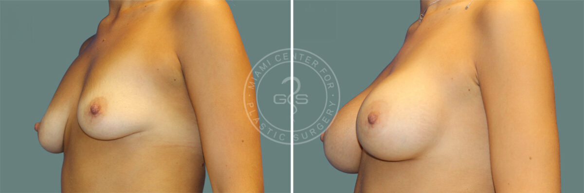 Breast Augmentation before and after photos in Miami Beach, FL, Patient 7355